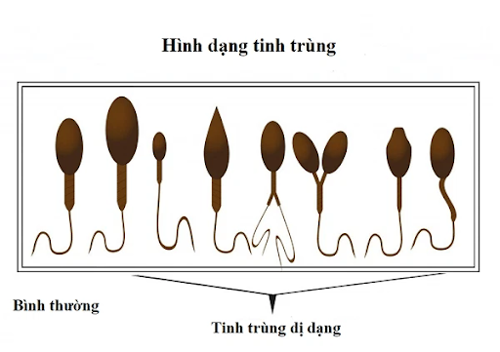 Tinh trùng dị dạng: Cách nhận biết và điều trị